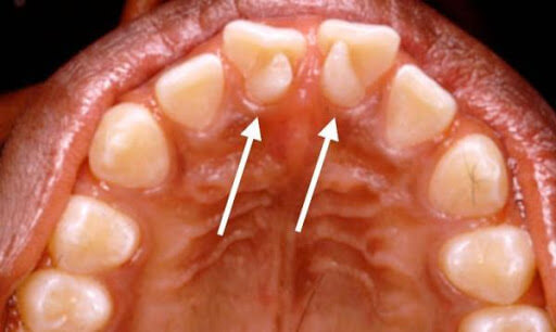 Зуб в зубе или инвагинация зубов