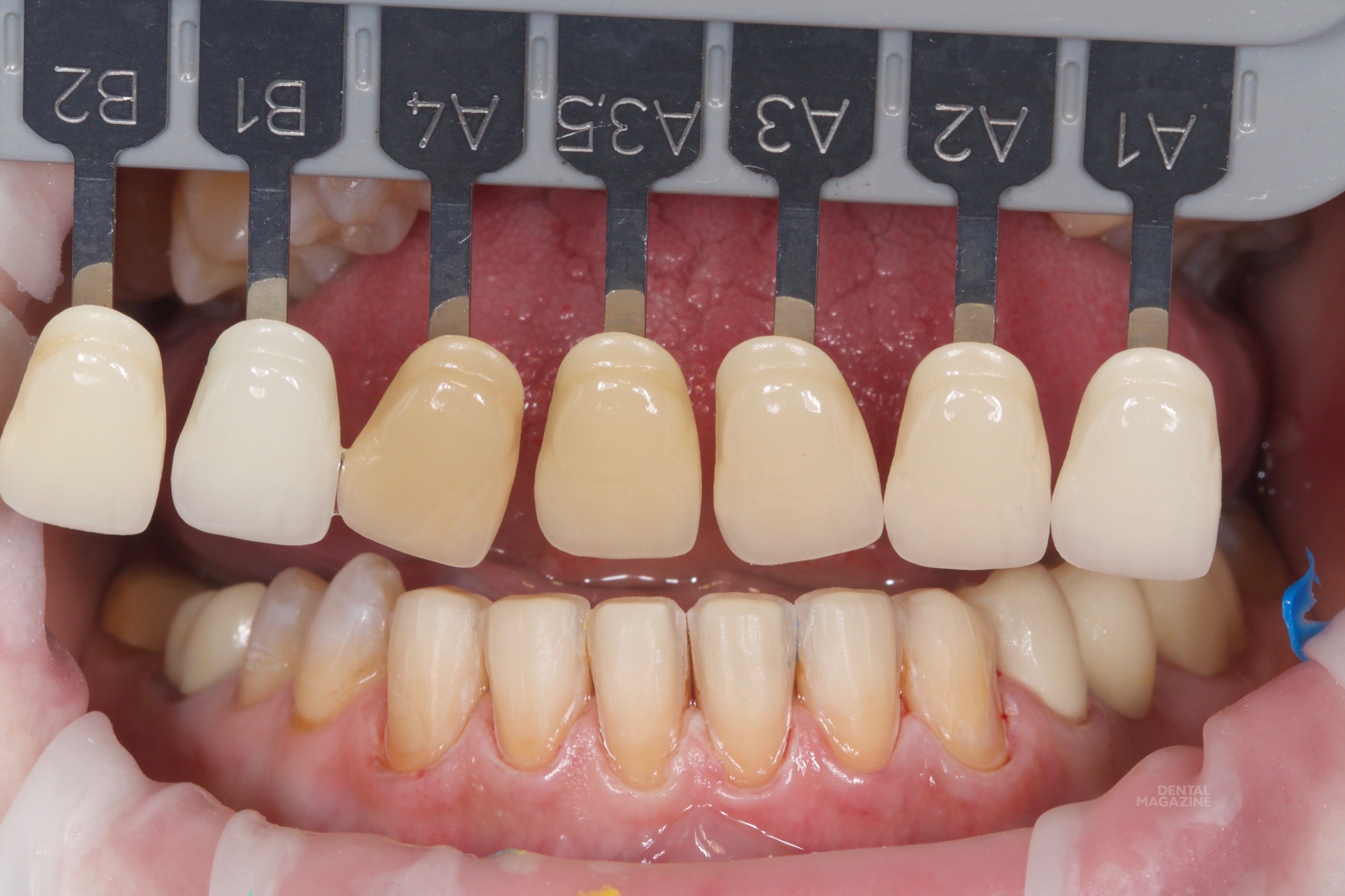 Как подобрать цвет зубов при протезировании