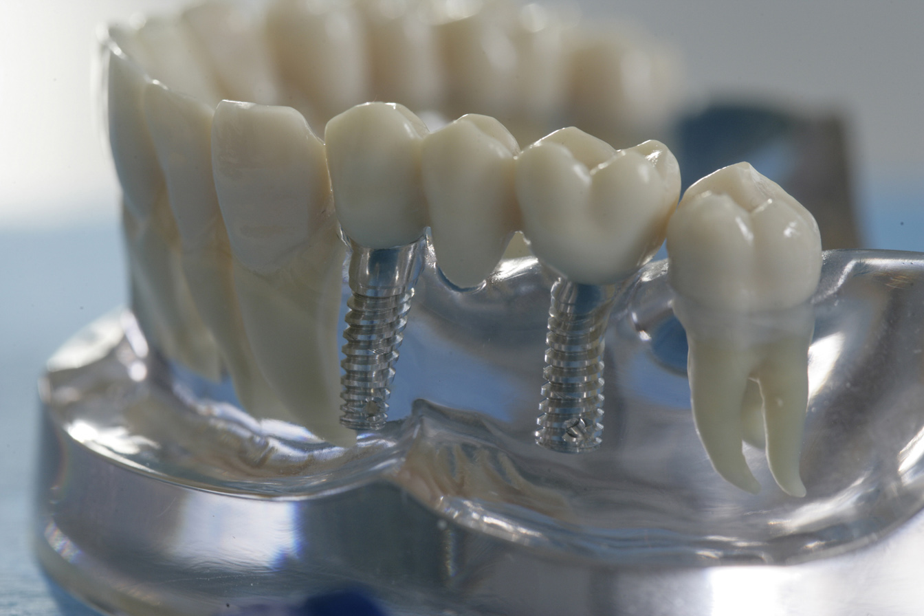 Виды протезирования зубов плюсы и минусы