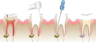 Депульпировать зубы перед протезированием