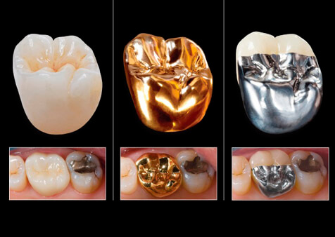 Как ставят коронку на зуб и сколько стоит процедура
