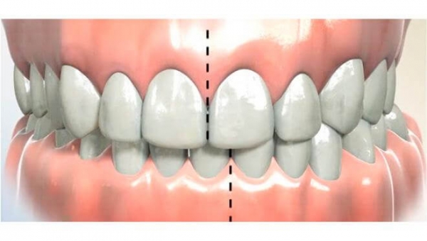Протезирование зубов при неправильном прикусе