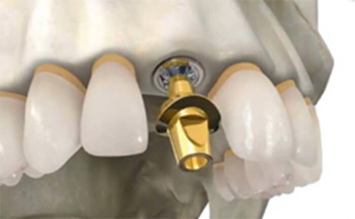 Проблемы восстановления целостности зубного ряда с помощью имплантов: изготовление заживляющего абатмента