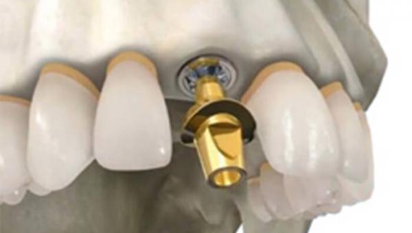 Проблемы восстановления целостности зубного ряда с помощью имплантов: изготовление заживляющего абатмента