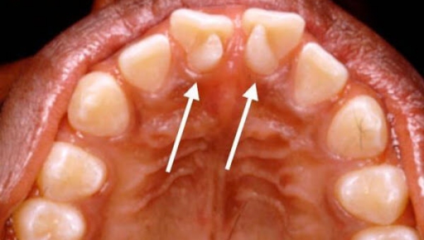 Зуб в зубе или инвагинация зубов