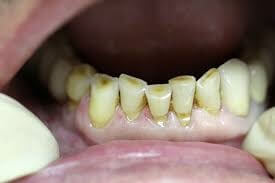 Новые стоматологические материалы для лечения повышенной стираемости зубов