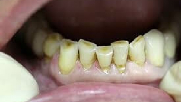 Новые стоматологические материалы для лечения повышенной стираемости зубов